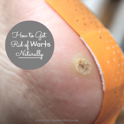 How To Get Rid Of Warts Naturally With One Ingredient Practical Stewardship - How To Get Rid Of A Wart Diy